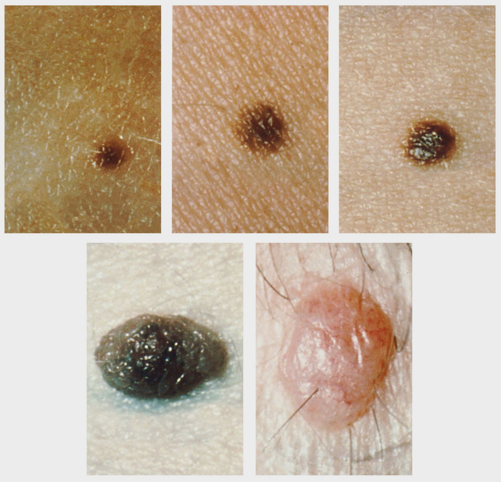 Common Moles